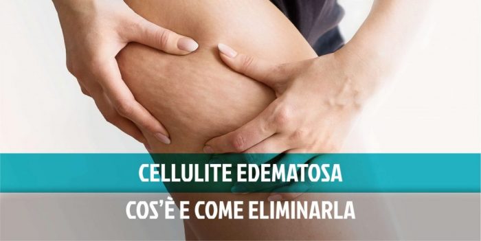 Cellulite edematosa: cos’è e come eliminarla davvero (rimedi efficaci)